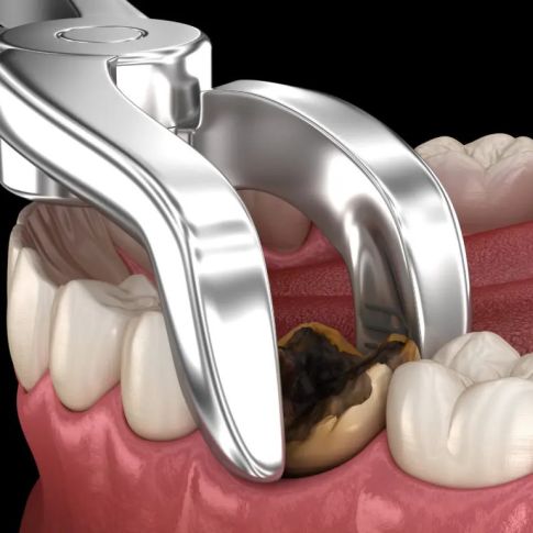 Cirugía dental moderna en Managua con el Dr. Helder Torres