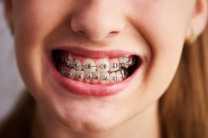 Cuánto cuesta ponerse brackets en Nicaragua